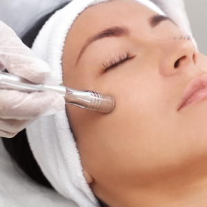 Microdermoabrasión-Facial-con-Punta-de-Diamante