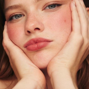 acido-hialuronico-labios-clinicasdh