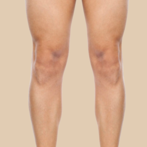 clinicasdh-laser-hombre-piernas